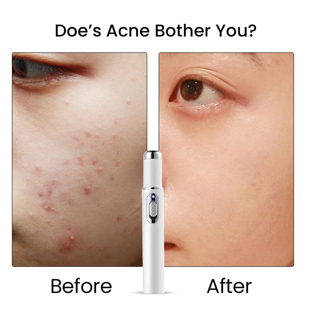 ClearSkin Home Laser Pen