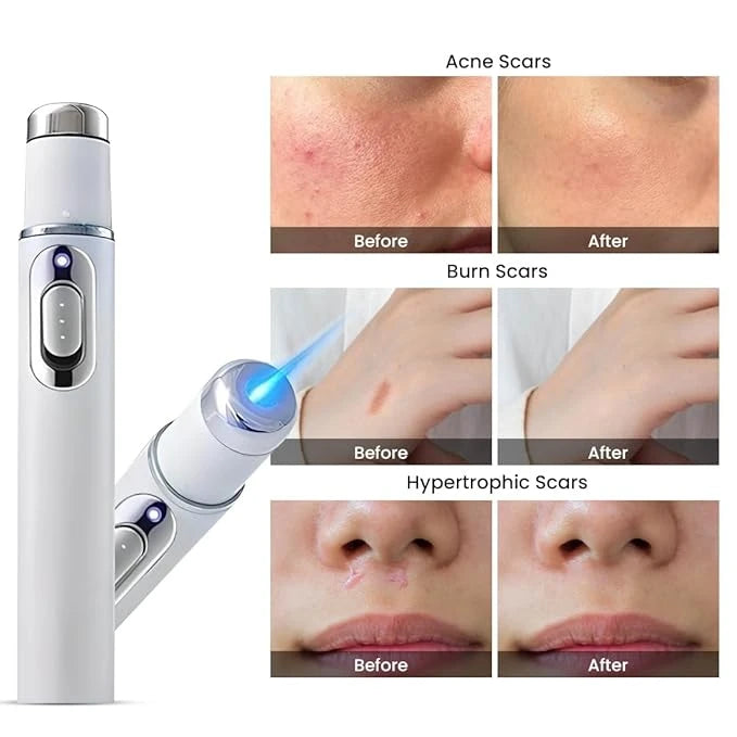 ClearSkin Home Laser Pen