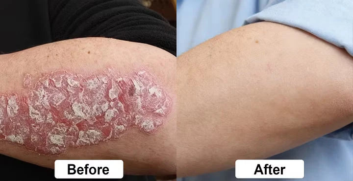Beef Tallow Itch Relief Spray