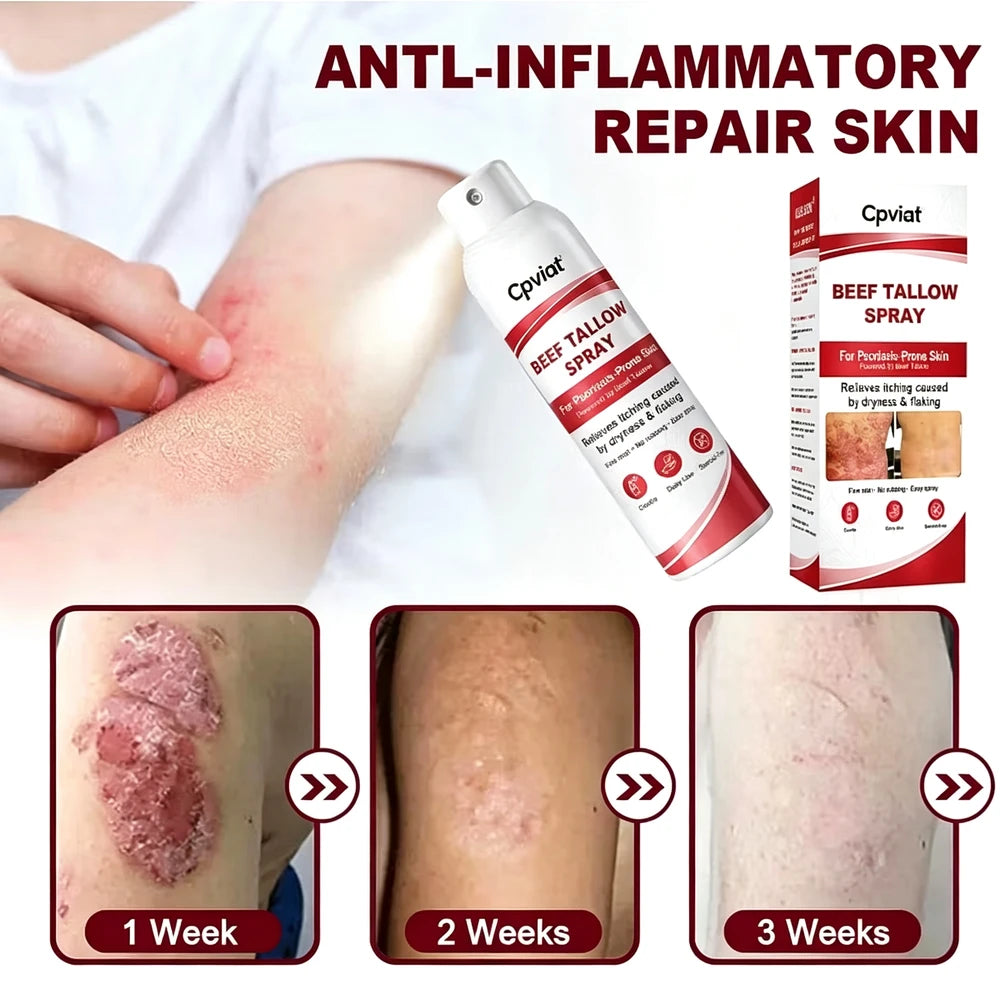 Beef Tallow Itch Relief Spray