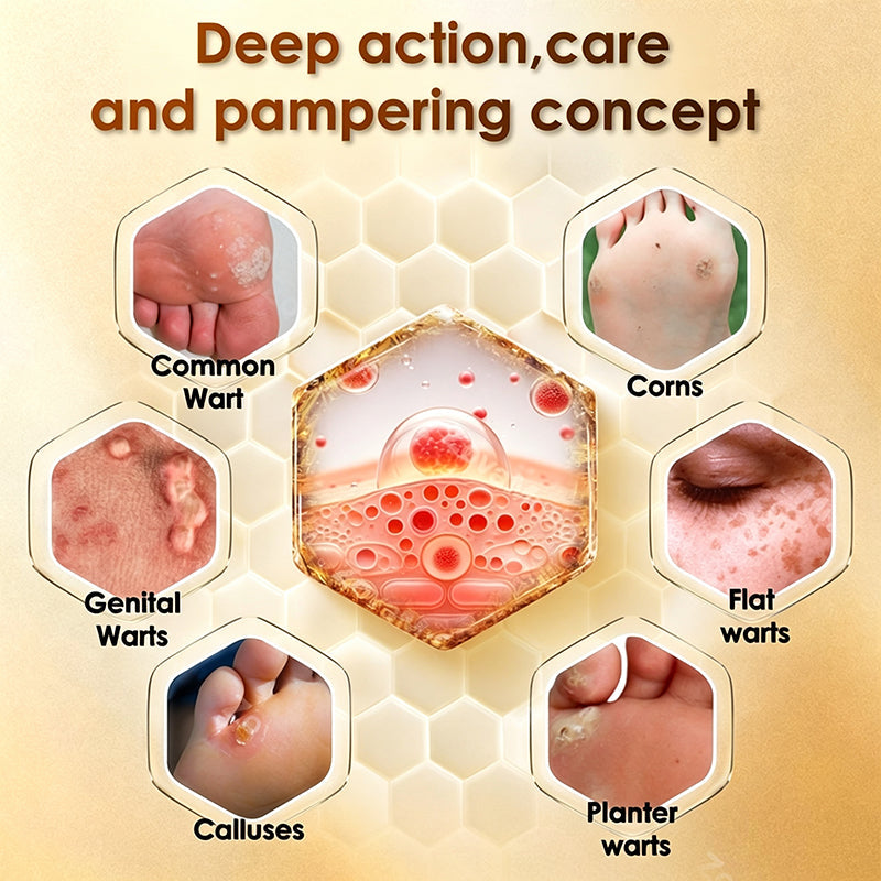 Bee Venom Corn and Callus Removal Cream | Soft Heels for Sandals