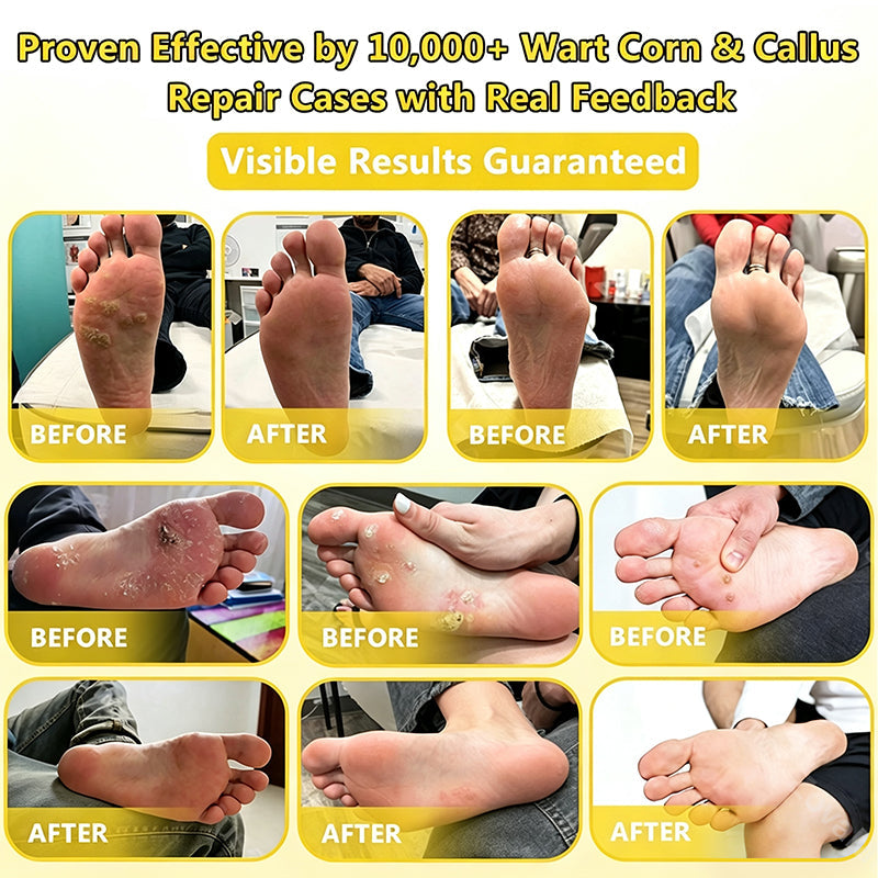 Bee Venom Corn and Callus Removal Cream | Soft Heels for Sandals
